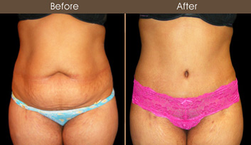Abdominoplasty Before And After Front Image